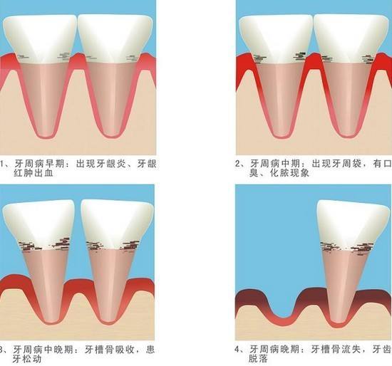 牙周炎或?qū)е掳柎暮D?患者